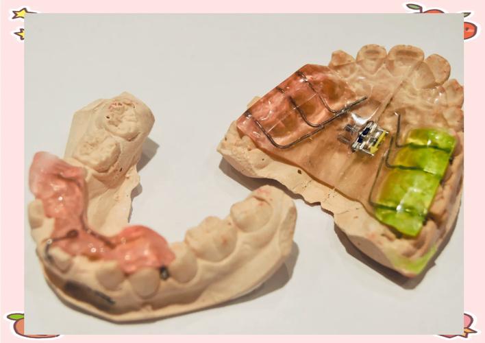 正畸治疗中常用器械有哪些类型及作用？-图1