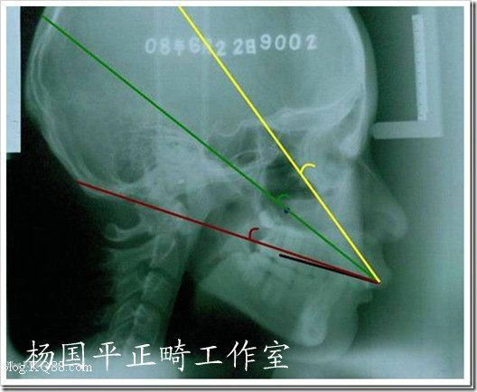 正畸阻抗中心，牙齿移动的力学支点是什么？-图1
