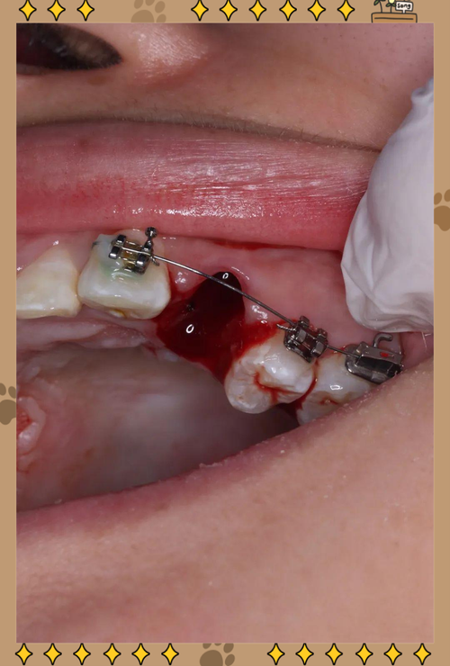 6号大牙拔除正畸-图1 6号大牙拔除正畸-图1