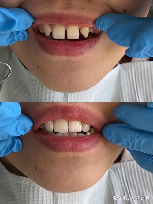 正畸后牙缝变大?原因何在?-图2 正畸后牙缝变大?原因何在?-图2