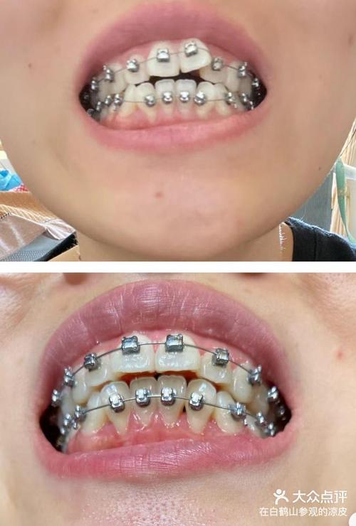 门牙开合想做正畸,矫正效果怎么样?-图2 门牙开合想做正畸,矫正效果怎么样?-图2