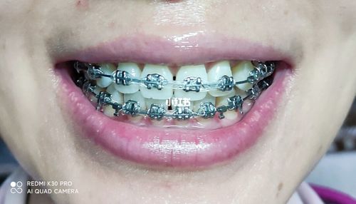 自己挂正畸橡皮链可行吗？关键操作技巧要掌握！-图1