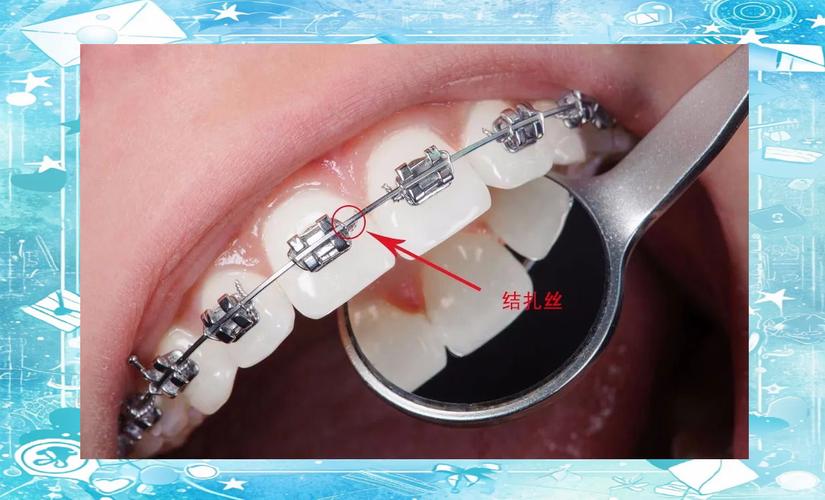 正畸有挂钩的托槽-图3