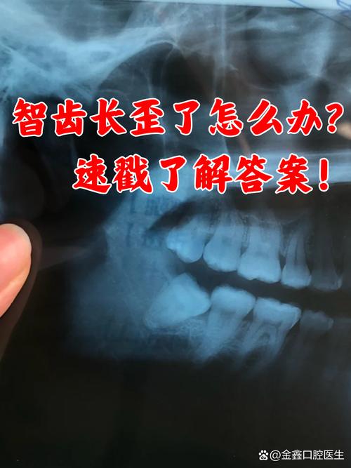 正畸后智齿冒头?原因何在?如何应对?-图2 正畸后智齿冒头?原因何在?如何应对?-图2