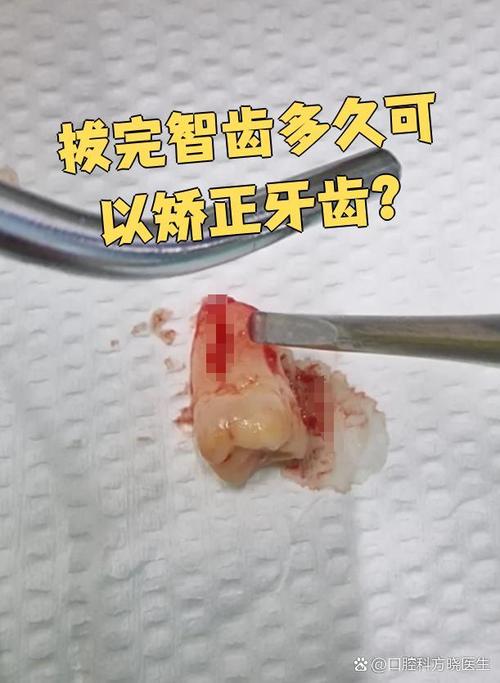 正畸后智齿冒头?原因何在?如何应对?-图3 正畸后智齿冒头?原因何在?如何应对?-图3