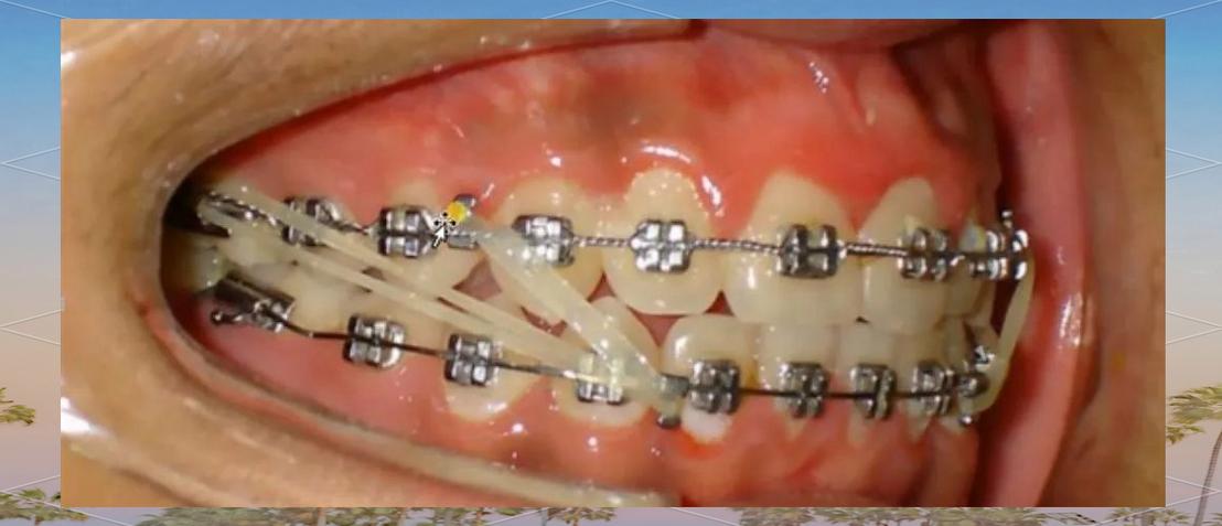 正畸牵引术后牙松动正常吗?原因及解决办法是什么?-图1 正畸牵引术后牙松动正常吗?原因及解决办法是什么?-图1