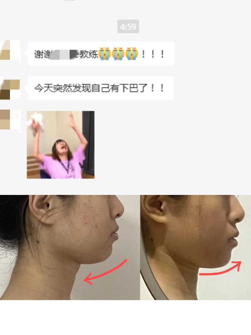 下颌后缩正畸手术效果如何?适合哪些情况?-图1 下颌后缩正畸手术效果如何?适合哪些情况?-图1