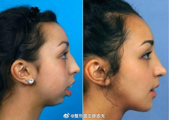 下颌后缩正畸手术效果如何?适合哪些情况?-图3 下颌后缩正畸手术效果如何?适合哪些情况?-图3