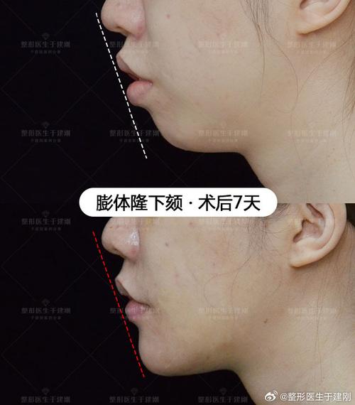下颌后缩正畸手术效果如何?适合哪些情况?-图2 下颌后缩正畸手术效果如何?适合哪些情况?-图2