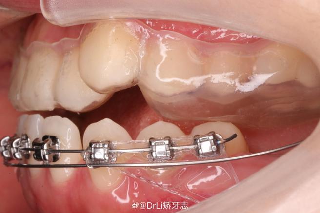 正畸下前牙打转矩-图2 正畸下前牙打转矩-图2