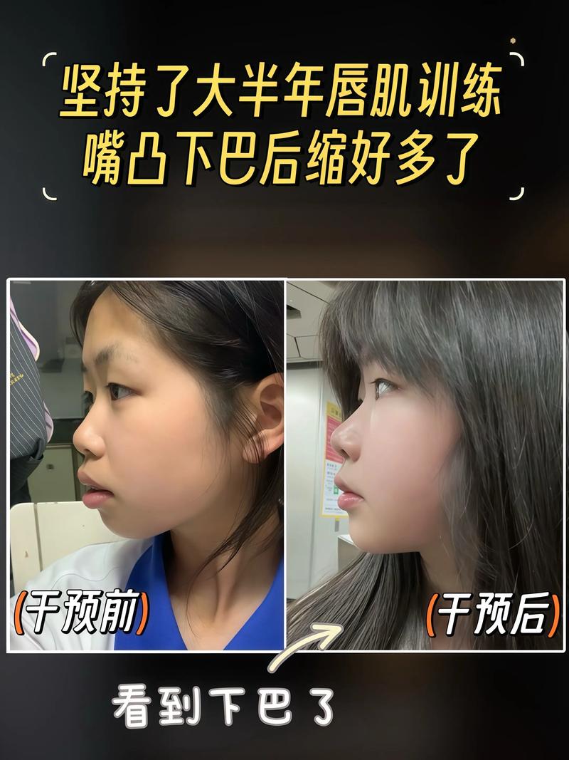 正畸真的会导致下巴后缩吗？-图2