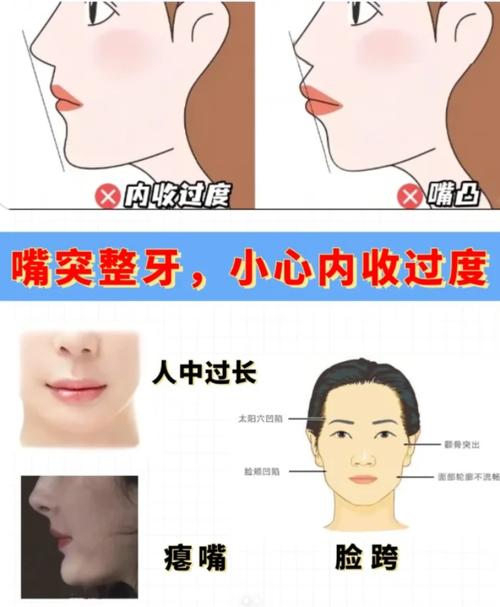 牙齿正畸内收过度,危害有哪些?-图1 牙齿正畸内收过度,危害有哪些?-图1