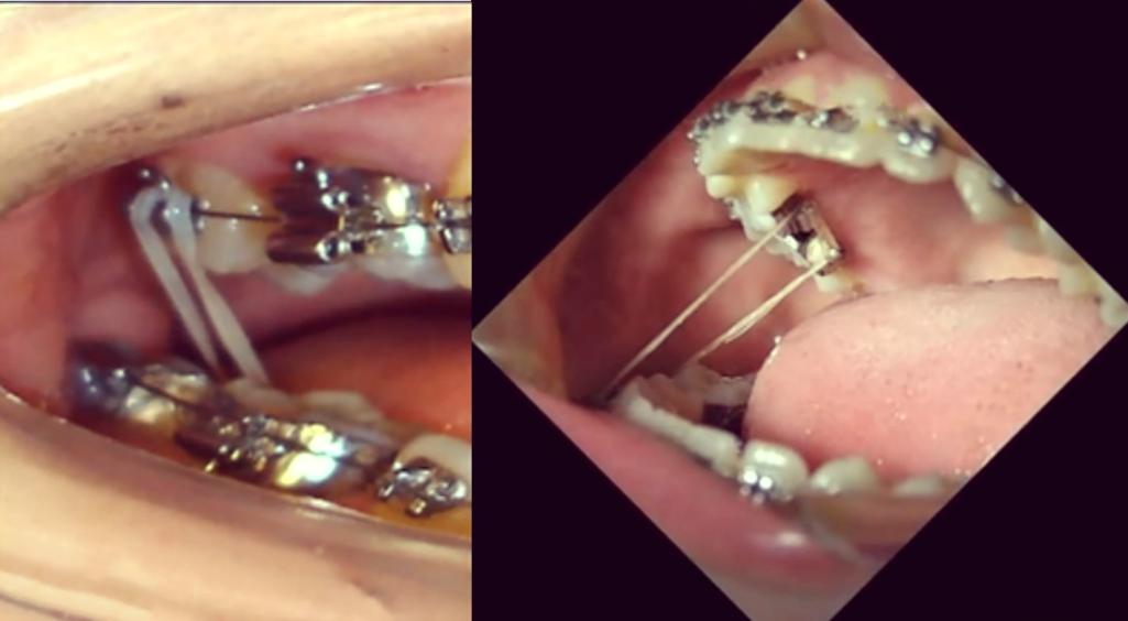 正畸支抗钉各种挂具体指哪些应用技巧？-图1
