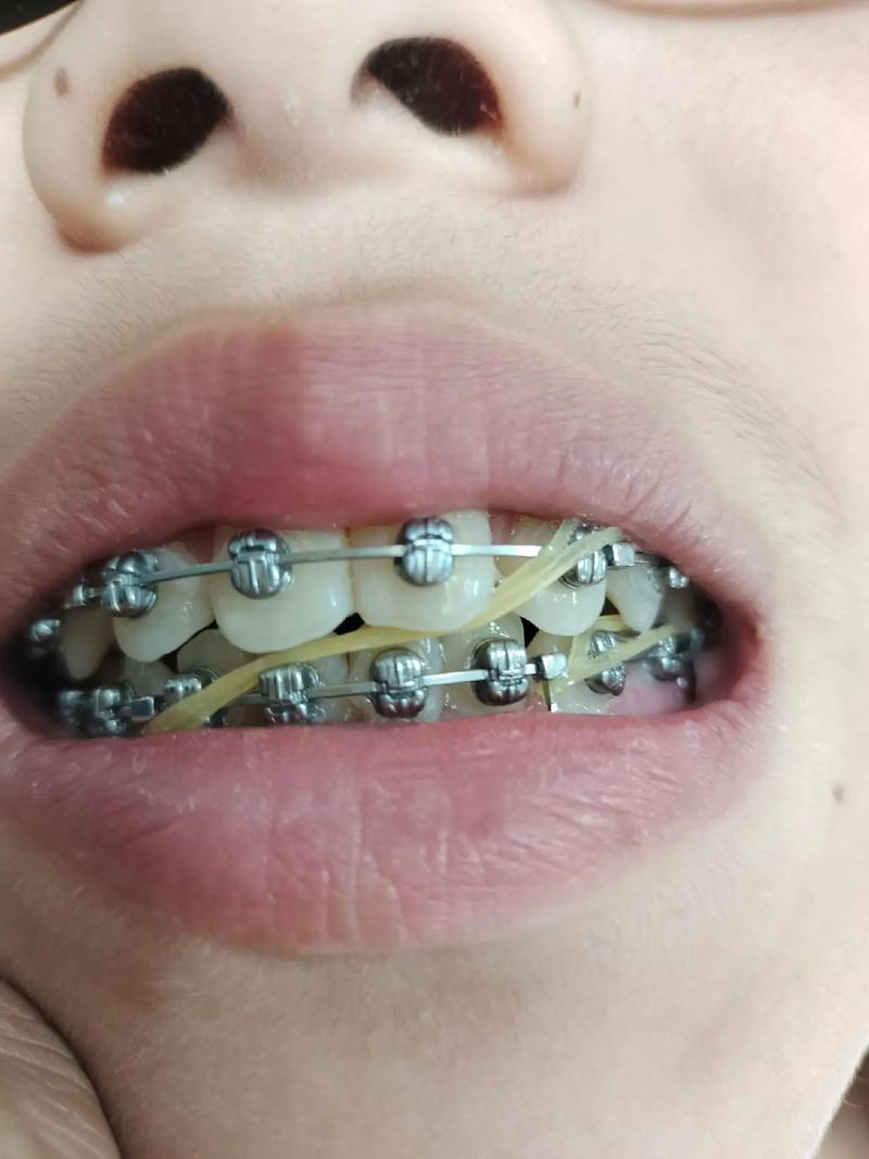 星耀系列正畸托槽-图2