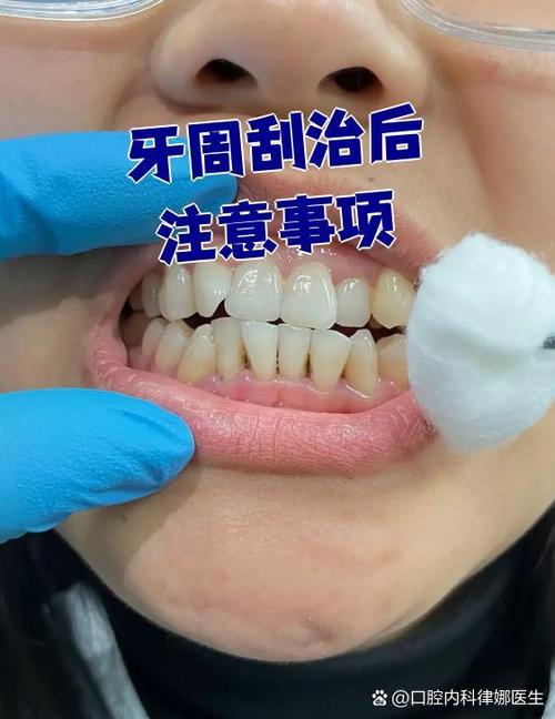 正畸前牙周刮治,为何是矫正成功的关键前提?-图3 正畸前牙周刮治,为何是矫正成功的关键前提?-图3