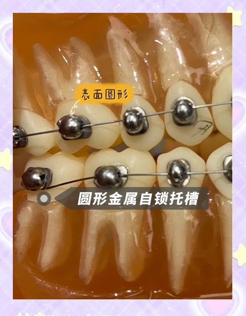 正畸托槽怎么选?哪种材质更适合你的牙齿?-图3 正畸托槽怎么选?哪种材质更适合你的牙齿?-图3