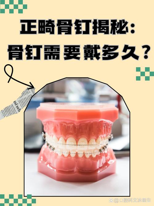 正畸支抗钉有哪些种类？常见类型及适用范围是什么？-图2