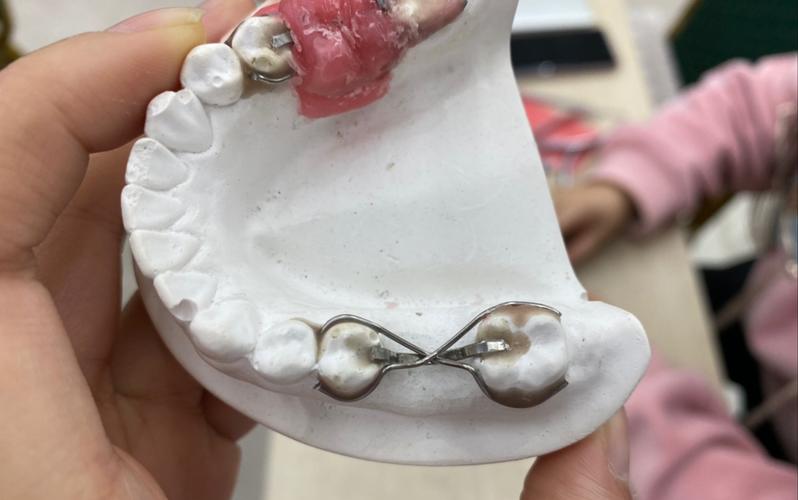 正畸卡环弯制图片-图2