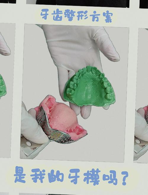 正畸印模制取为何关键?步骤要点与临床应用解析-图1 正畸印模制取为何关键?步骤要点与临床应用解析-图1