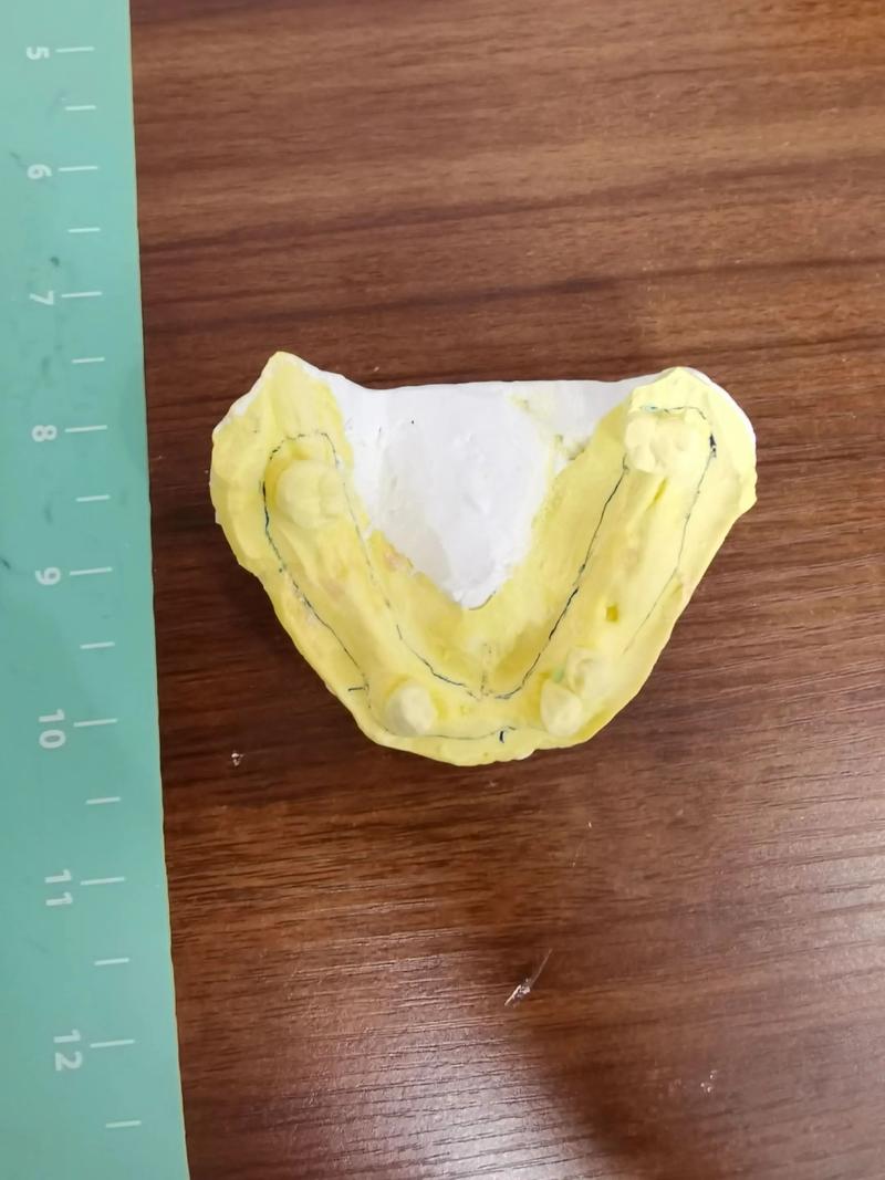 正畸印模制取为何关键?步骤要点与临床应用解析-图2 正畸印模制取为何关键?步骤要点与临床应用解析-图2