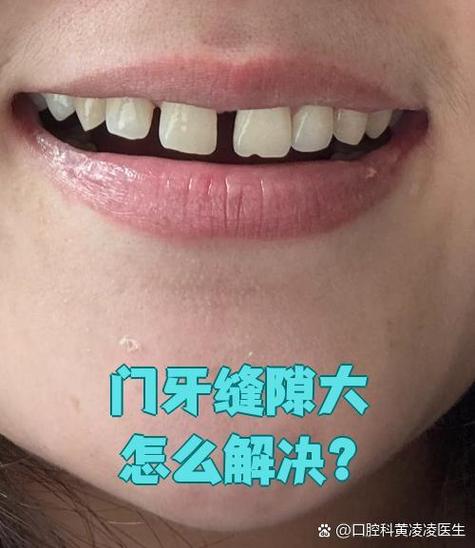 正畸中门牙有缝隙是什么原因导致的？-图3