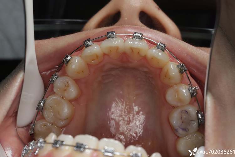 齿性龅牙正畸手术效果如何？-图1