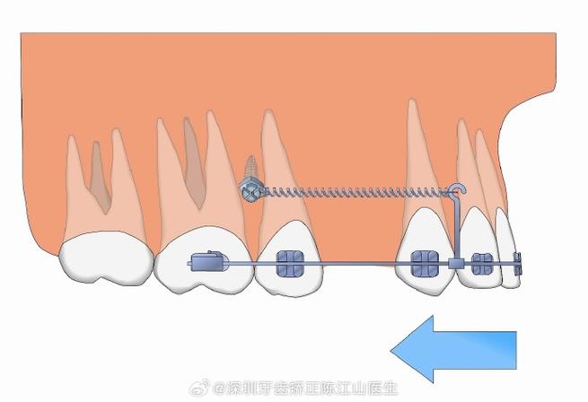 正畸种植钉植入步骤，打钉的关键步骤有哪些？-图3