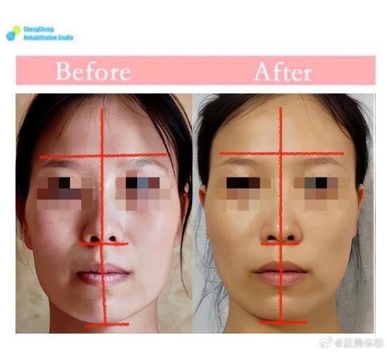 正畸能改变颧骨吗-图1 正畸能改变颧骨吗-图1