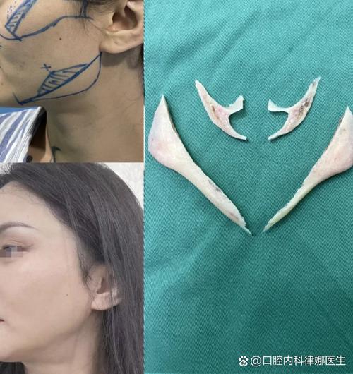 正畸能改变颧骨吗-图2 正畸能改变颧骨吗-图2