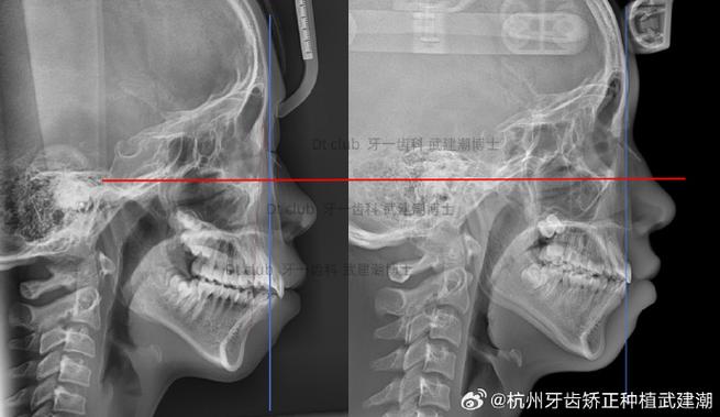 正畸复发 牙槽骨-图2 正畸复发 牙槽骨-图2