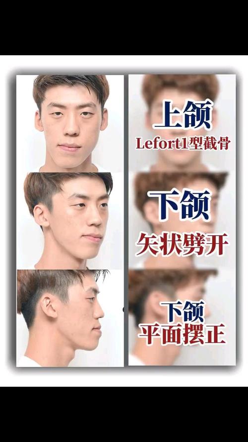 成年正畸能改善偏颌吗?效果及方法有哪些?-图2 成年正畸能改善偏颌吗?效果及方法有哪些?-图2