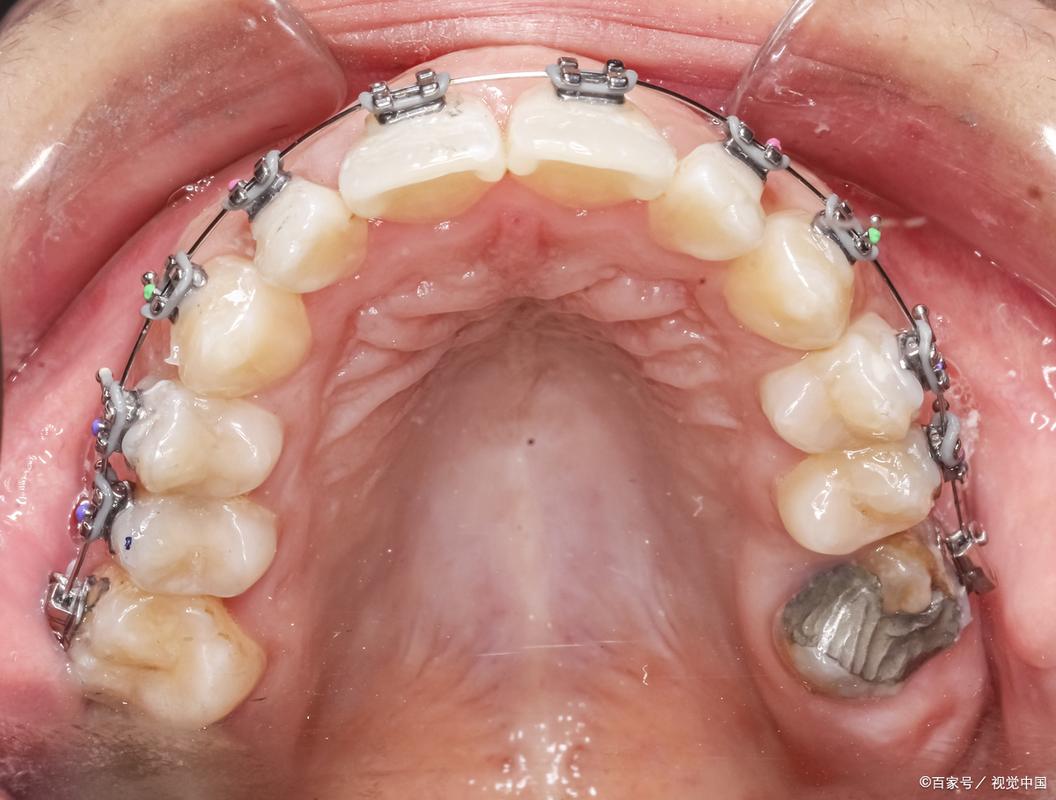 正畸磨牙为何要做?对牙齿有何影响?-图2 正畸磨牙为何要做?对牙齿有何影响?-图2