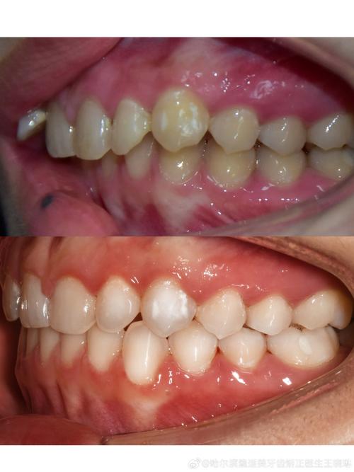 正畸磨牙为何要做?对牙齿有何影响?-图3 正畸磨牙为何要做?对牙齿有何影响?-图3