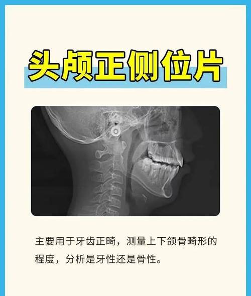 正畸头颅片怎么拍?拍摄步骤、要点与注意事项有哪些?-图2 正畸头颅片怎么拍?拍摄步骤、要点与注意事项有哪些?-图2