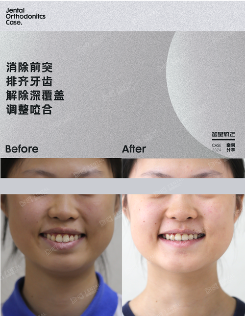 正畸治疗后效果如何?分享牙齿矫正的真实变化与心得?-图2 正畸治疗后效果如何?分享牙齿矫正的真实变化与心得?-图2