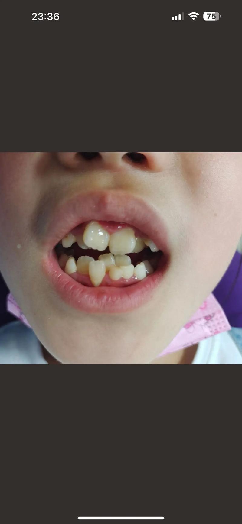 牙齿正畸上下不齐-图2