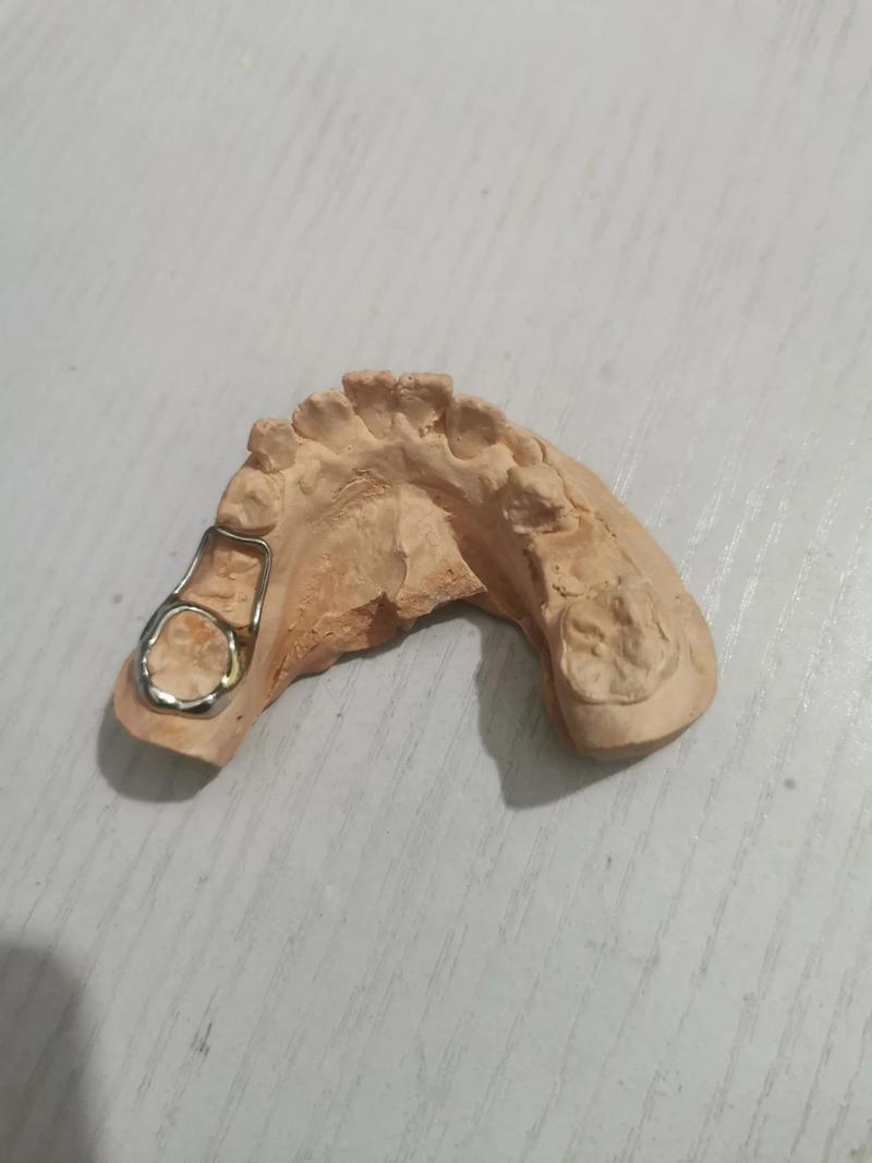 正畸保持器 磨牙-图2