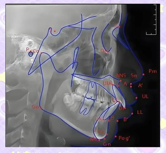 如何理解普特正畸头影测量的应用差异?-图1 如何理解普特正畸头影测量的应用差异?-图1
