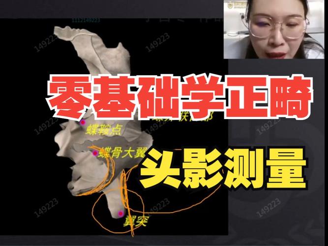 如何理解普特正畸头影测量的应用差异?-图2 如何理解普特正畸头影测量的应用差异?-图2