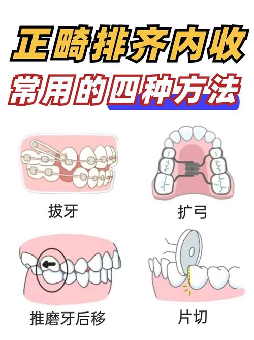 正畸为什么要磨牙-图2 正畸为什么要磨牙-图2