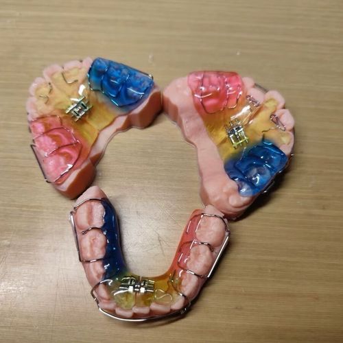 正畸固定扩弓病例的临床关键点有哪些？-图1