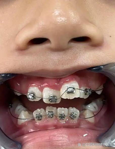 成人开颌隐形正畸可行吗?效果能维持多久?注意事项有哪些?-图3 成人开颌隐形正畸可行吗?效果能维持多久?注意事项有哪些?-图3