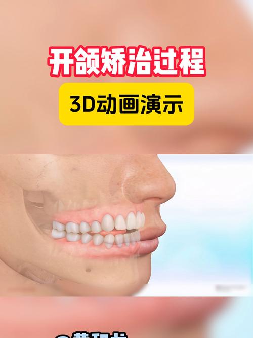 正畸中期变成开颌-图1