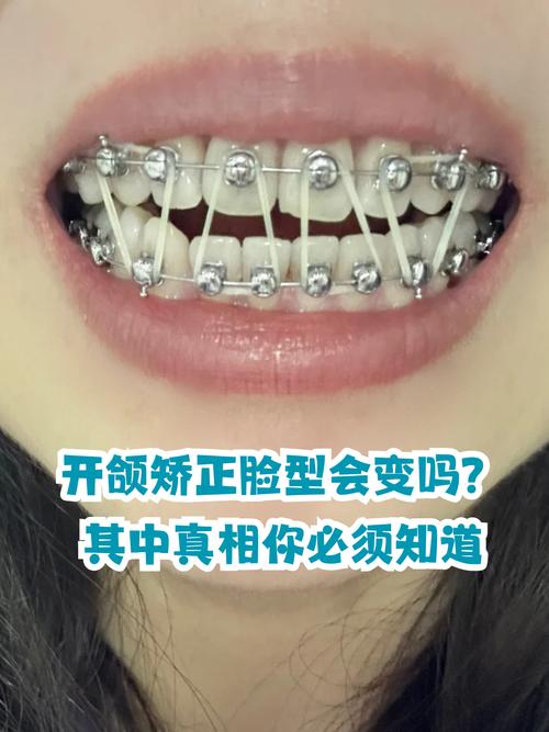 正畸中期变成开颌-图3