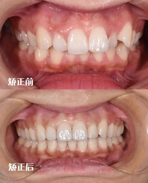 正畸前后X光对比,牙齿骨骼有何变化?-图1 正畸前后X光对比,牙齿骨骼有何变化?-图1