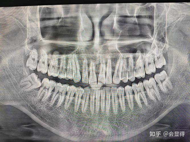 正畸时为啥能发现智齿？检查手段是什么？-图2
