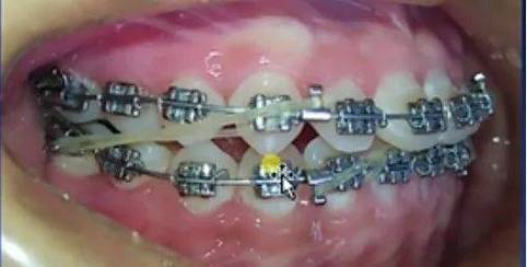 正畸牵引钩使用会导致嘴部不适吗？-图1