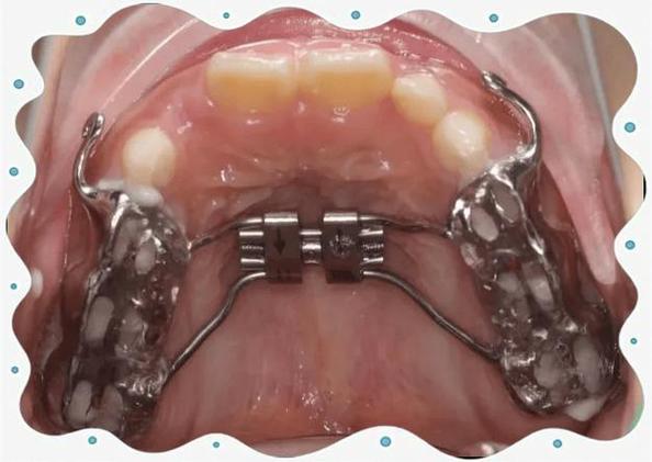 正畸牵引钩使用会导致嘴部不适吗？-图2
