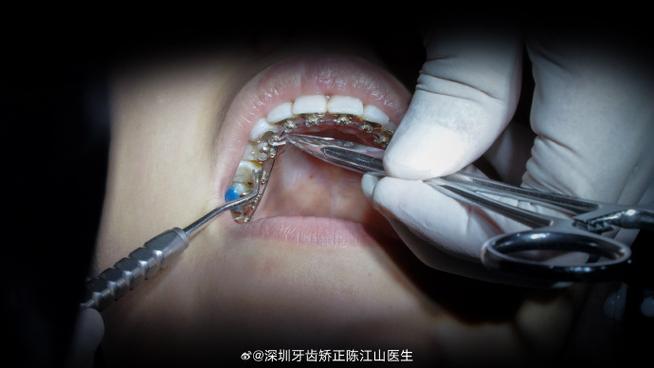 舌侧正畸多久复诊-图2