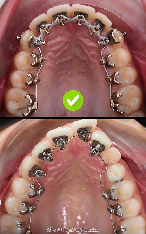 舌侧正畸多久复诊-图3